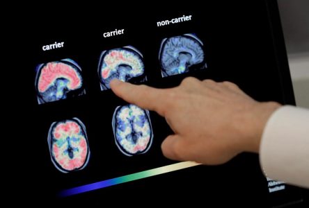 Alzheimer : des dépôts de gras mis en cause