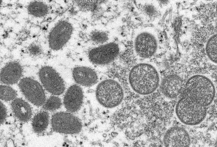 OMS: pas de pandémie de variole simienne, mais…