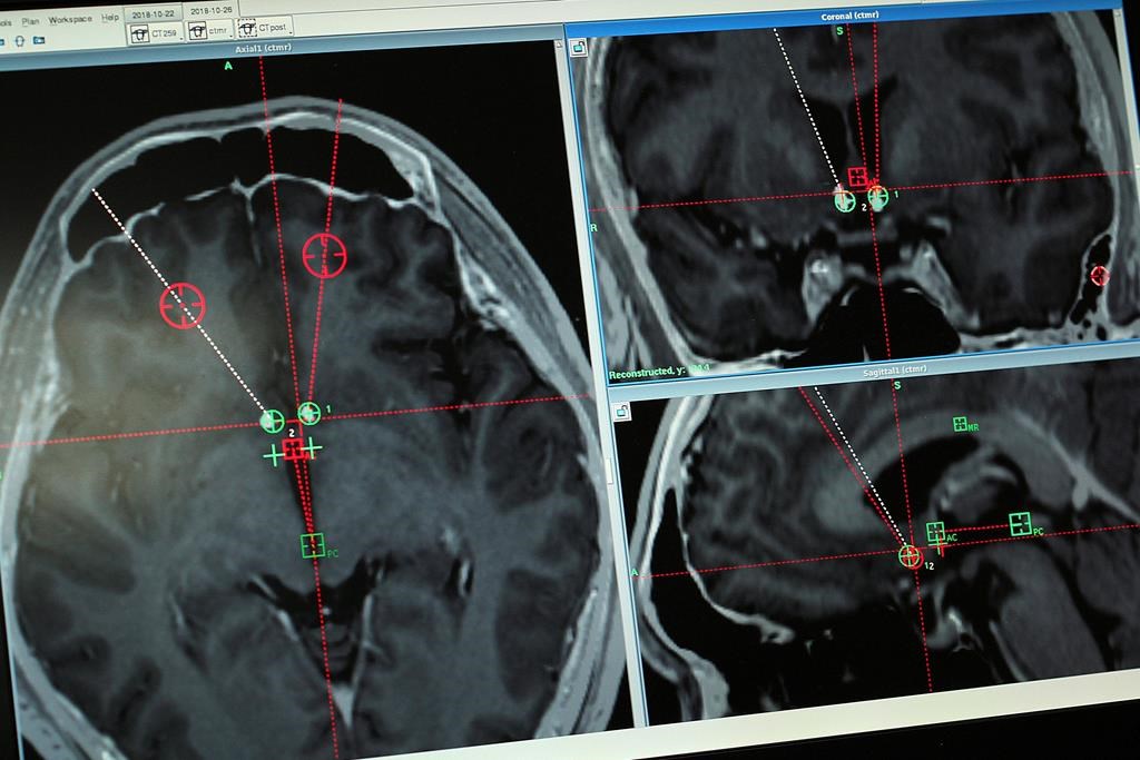 Nouvelle étude sur la santé cognitive des aînés